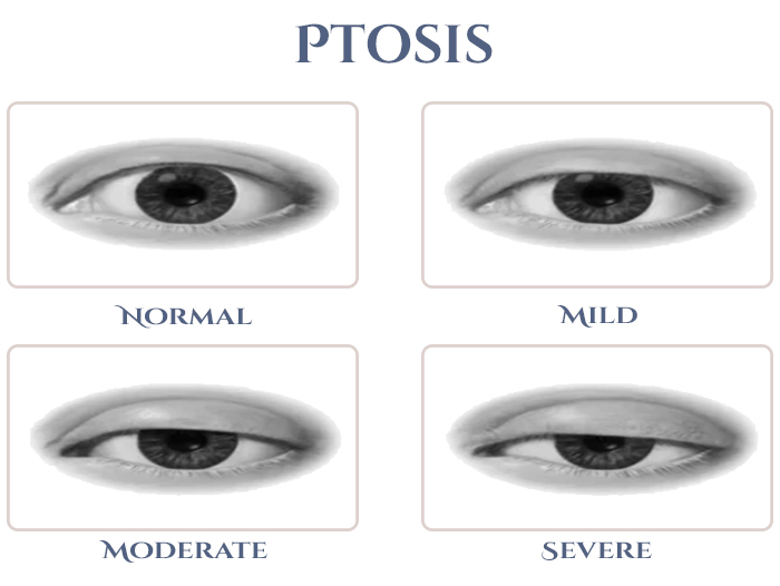 ptosis diagram