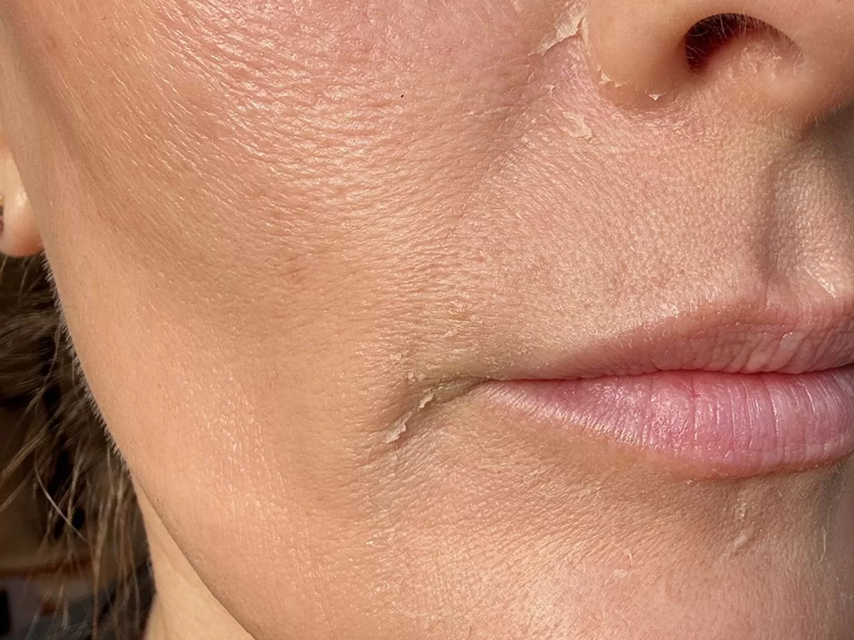 Cell turnover on face