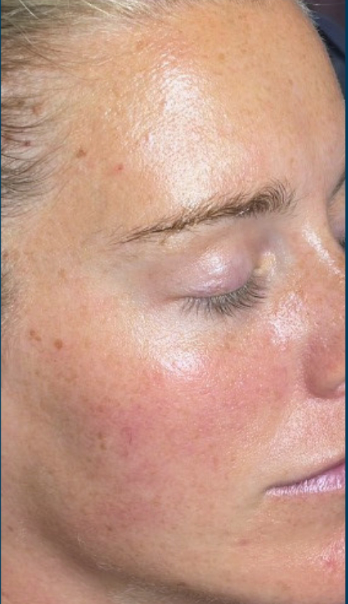 Patient After SkinPen Treatment