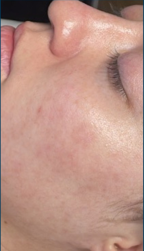 Patient After SkinPen