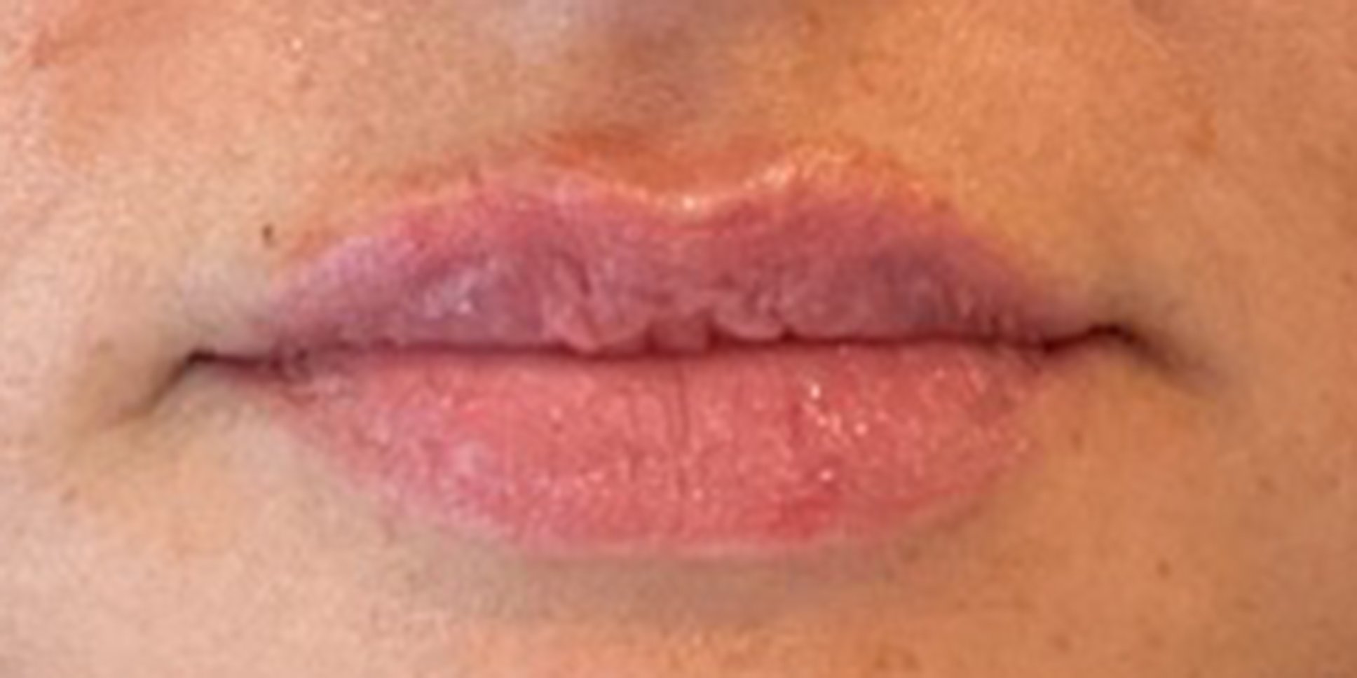 After Lip Filler Treatment