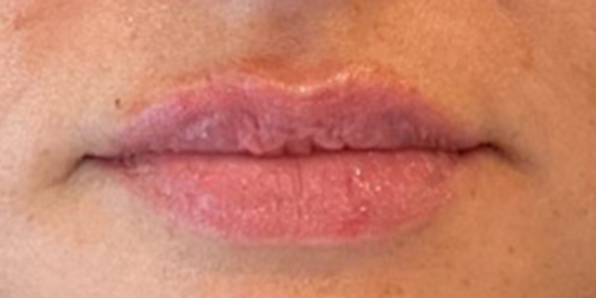 After Lip Filler Treatment