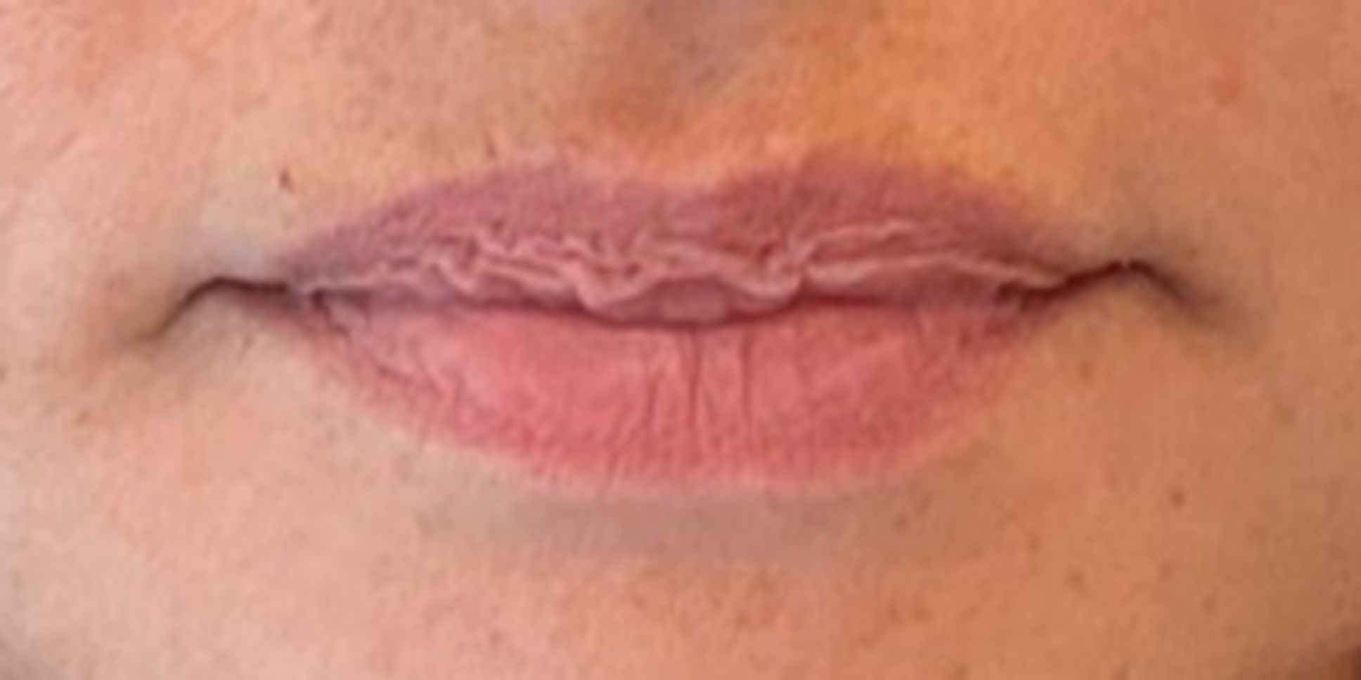 Before Lip Filler Treatment