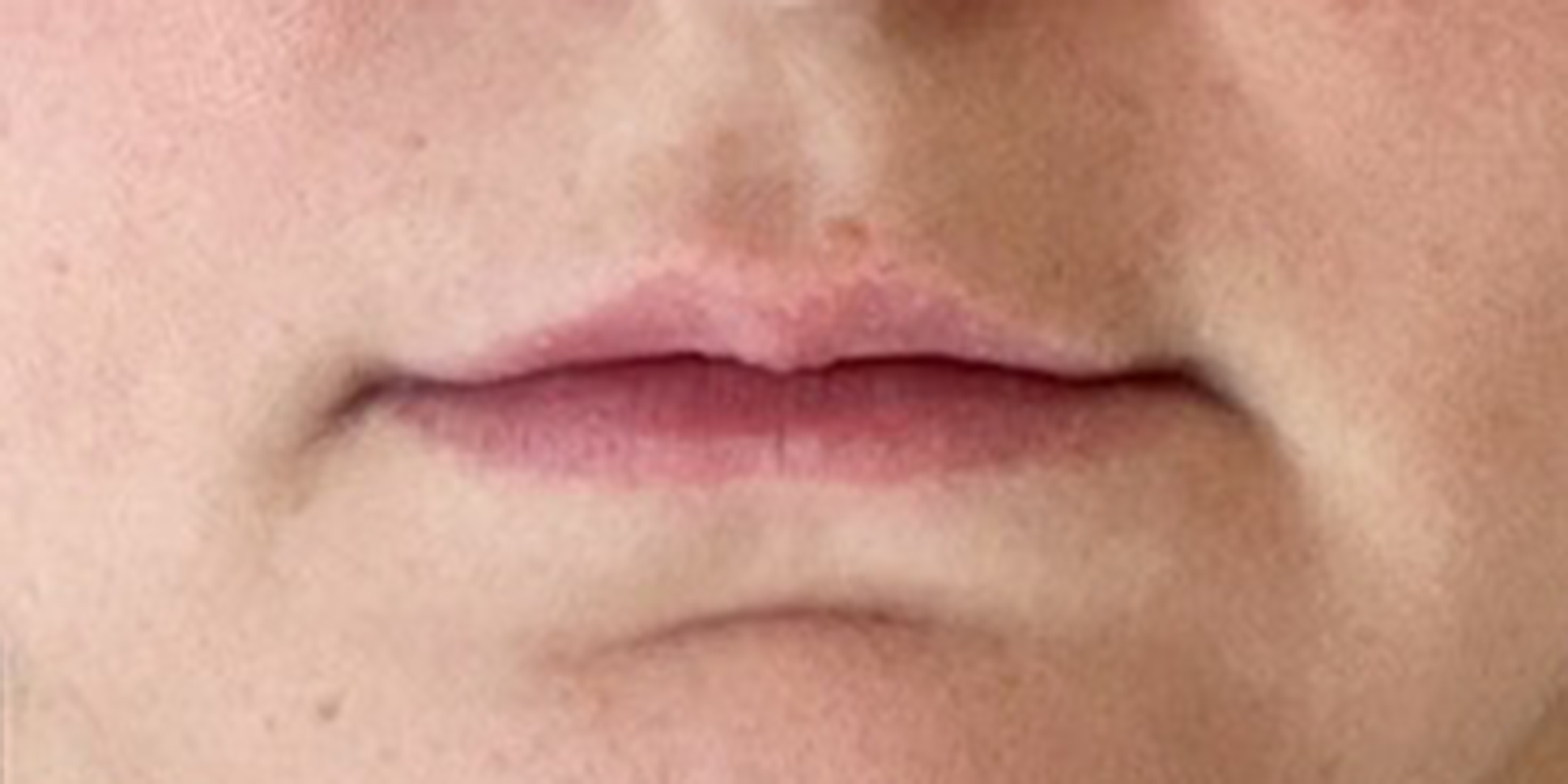After Lip Filler Injections