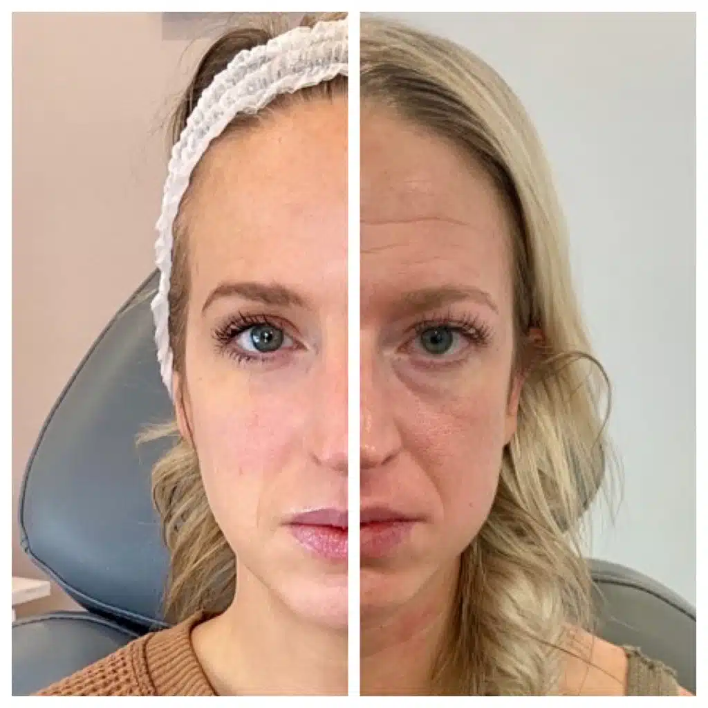 Before and After Photo of Sculptra Treatment
