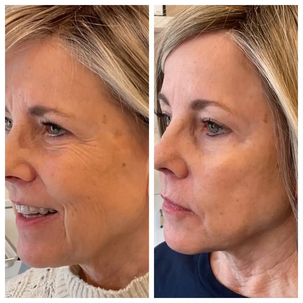 Before After Sculptra 3