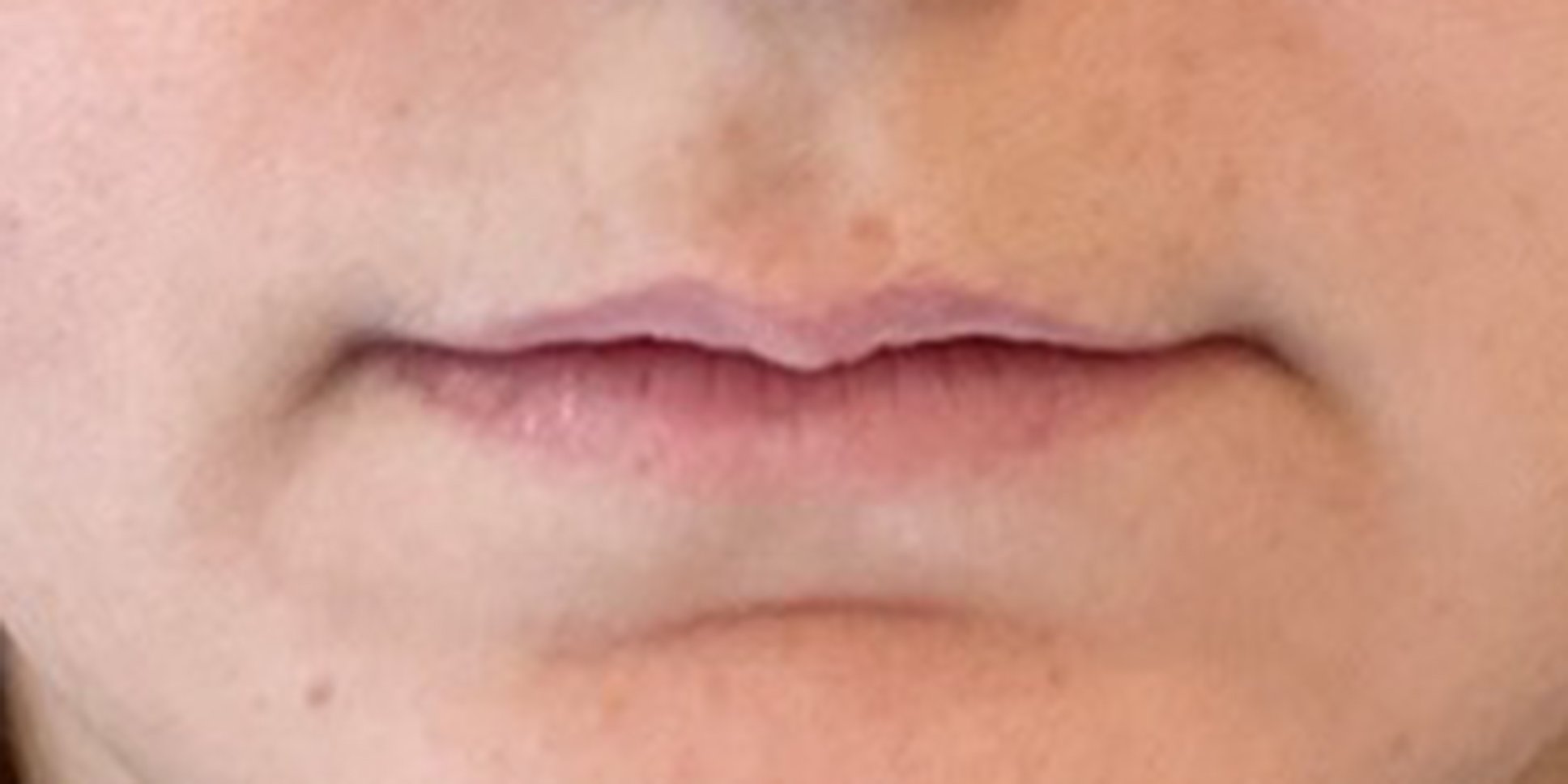 Before Lip Filler Injections