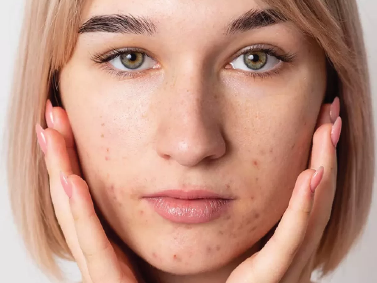 female with acne touching face with hands
