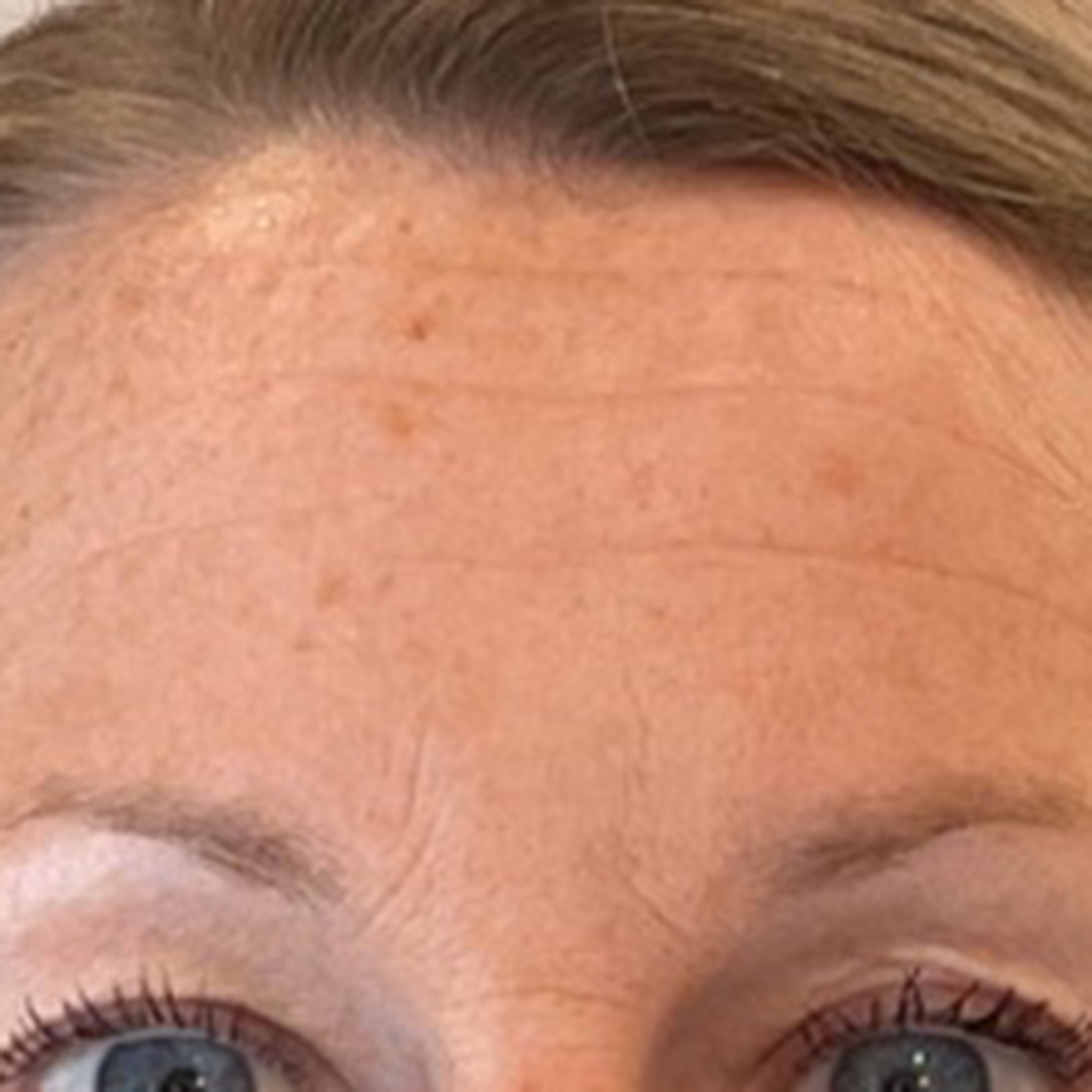 Before Botox Treatment on Forehead Lines