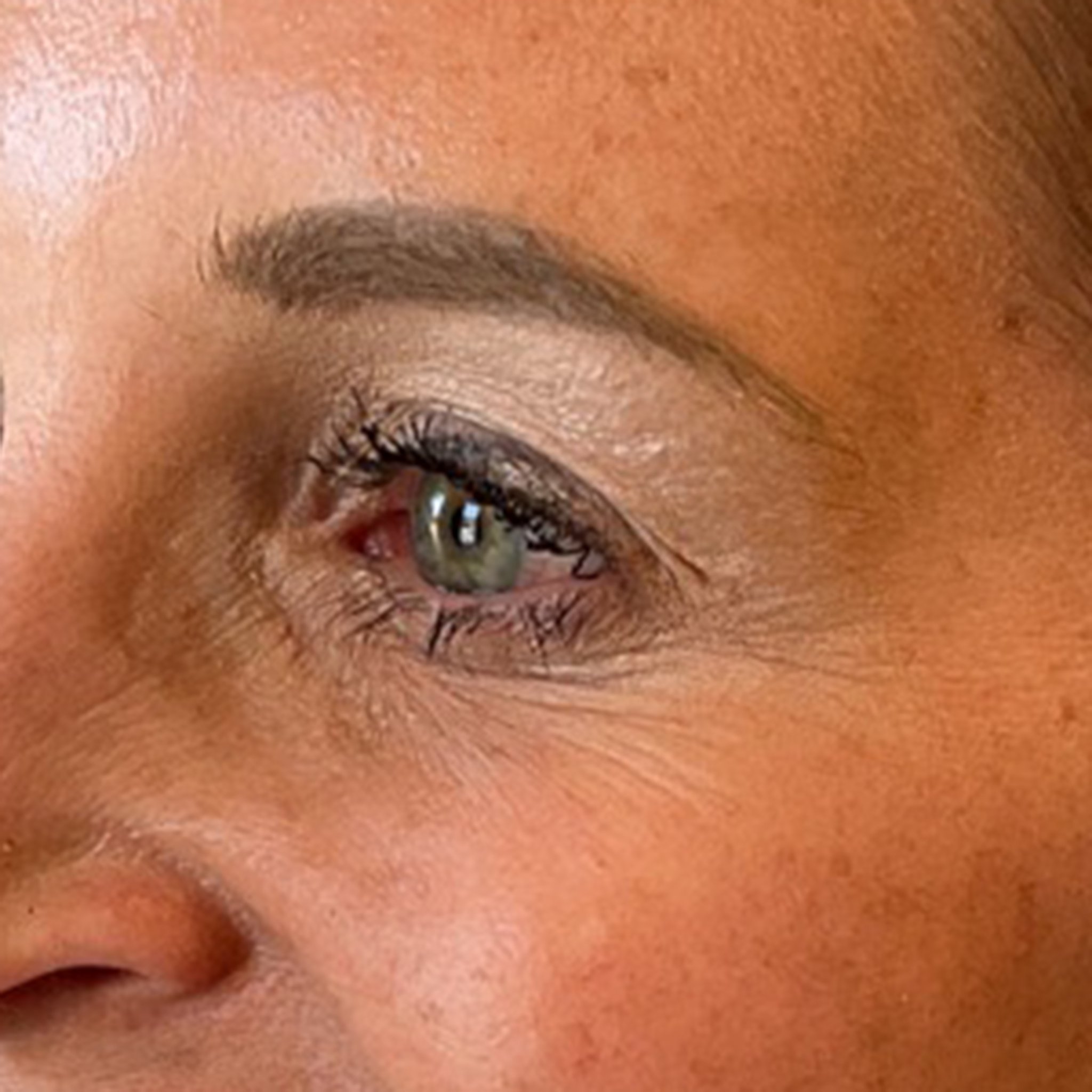 After Botox Crows Feet Treatment