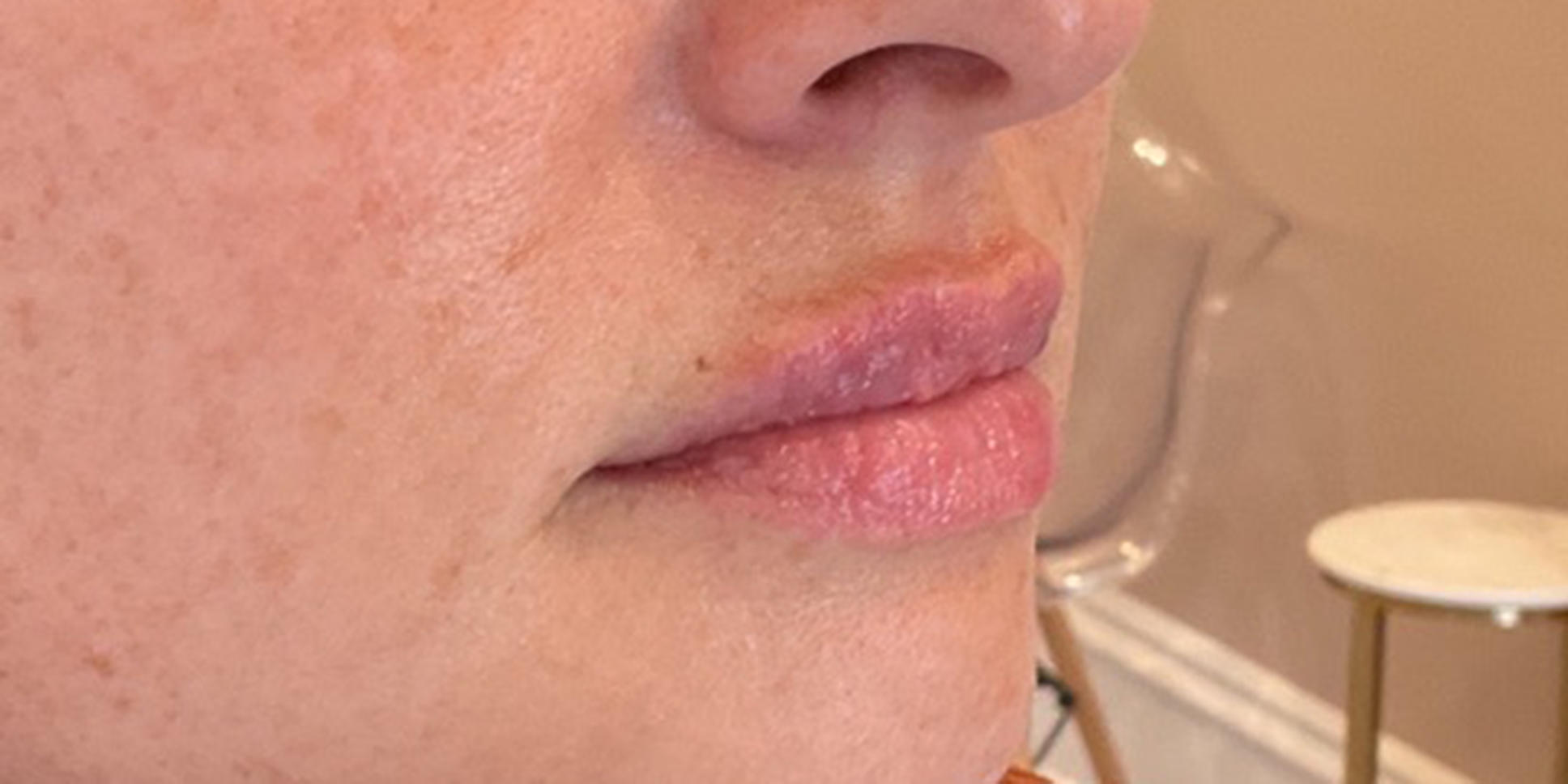 After Lip Filler Treatment