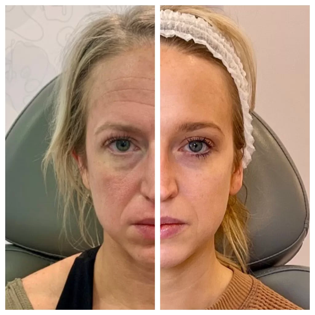 Before and After Photo using Sculptra