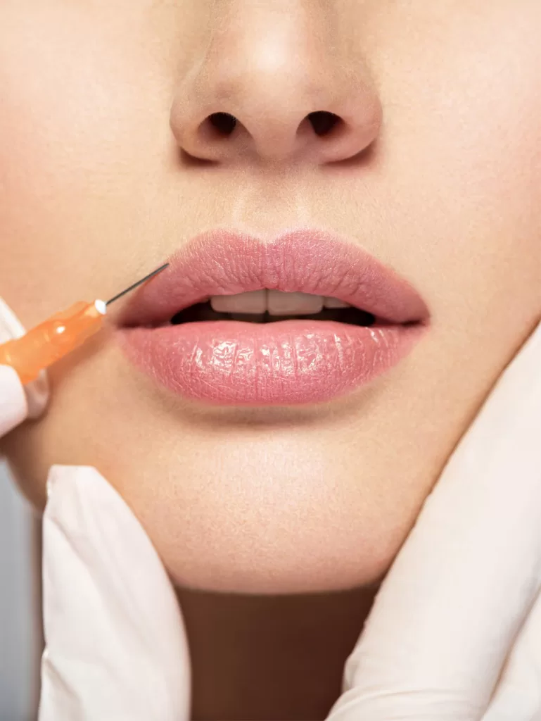 Lip Flip treatment using Botox on a patients lips
