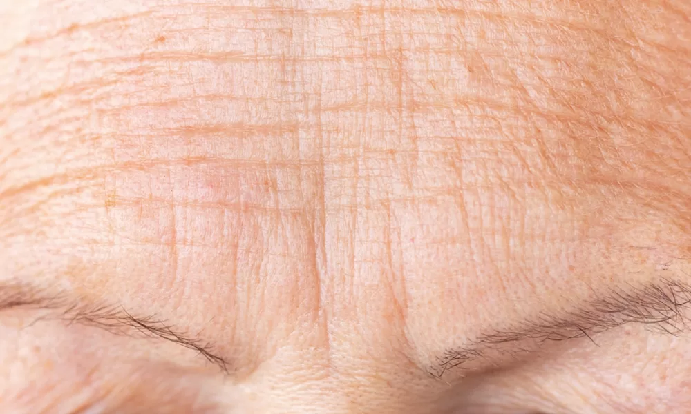 female with forehead lines, wrinkles