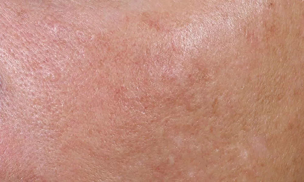 female with hyperpigmentation on face