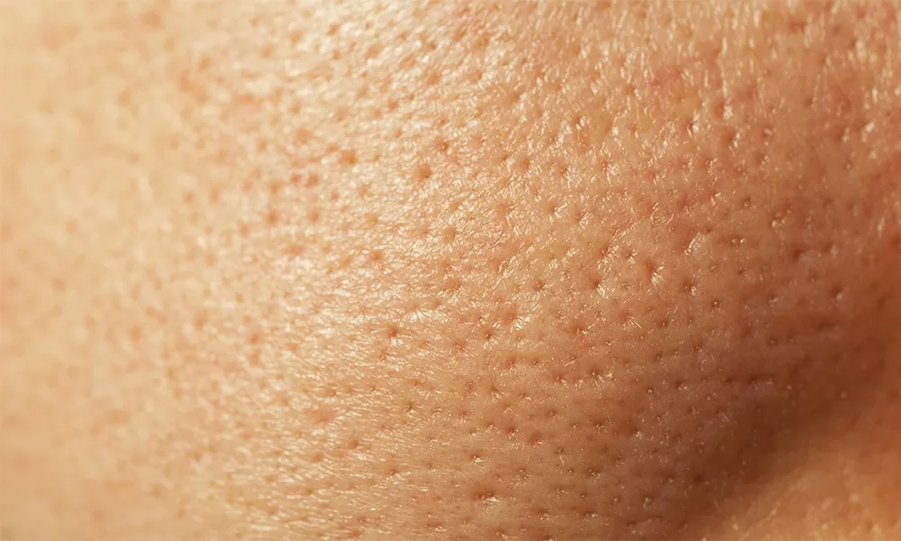 close up of large pores on skin