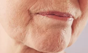 close up of Marionette lines from corners of mouth down to chin