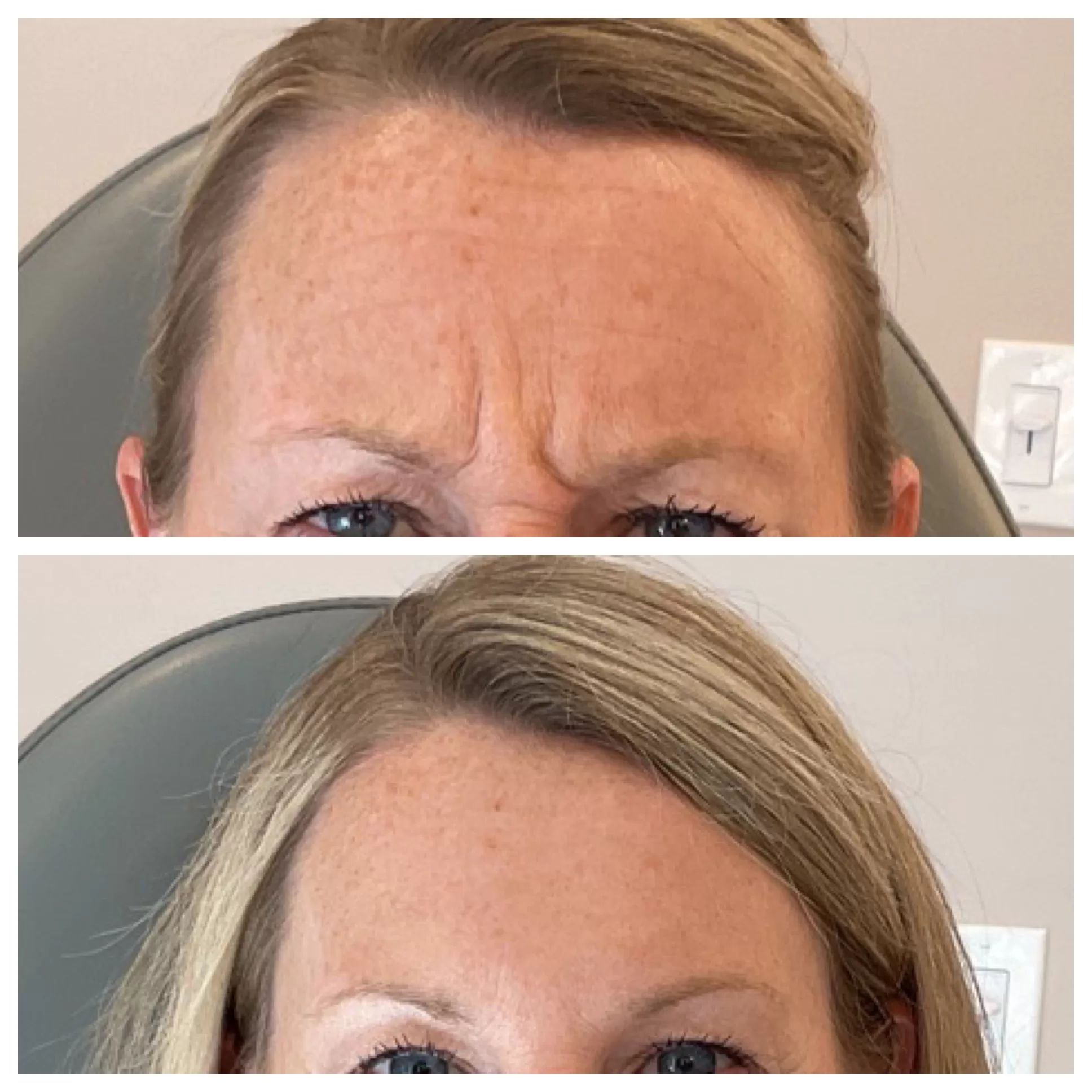 Everything You Need To Know About Forehead Botox For Wrinkles Everything You Need To Know About Forehead Botox For Wrinkles