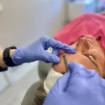 Female patient receiving dermaplaning treatment by Direct Aesthetics medical provider