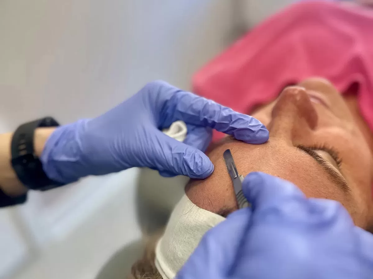 Female patient receiving dermaplaning treatment by Direct Aesthetics medical provider