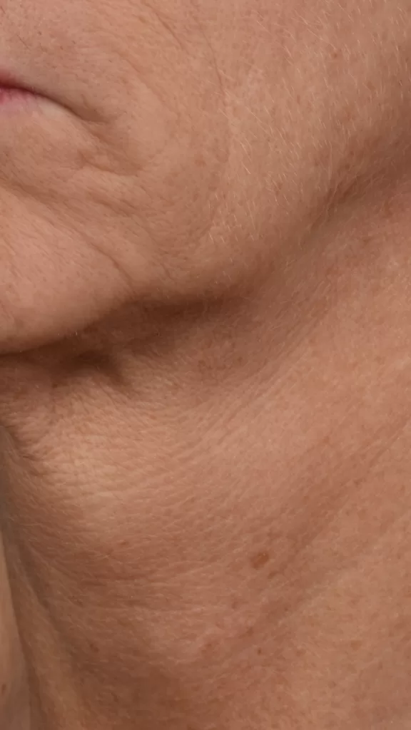 closeup of patient neck after Microneedling 
