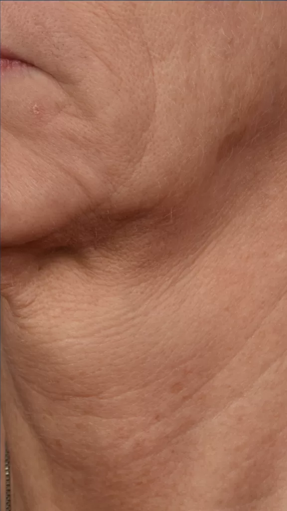closeup of patient neck before Microneedling 