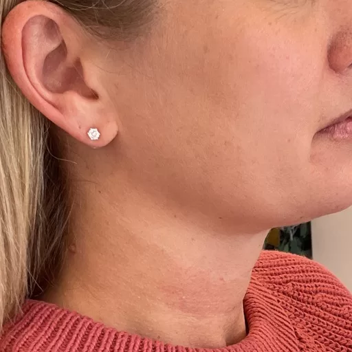 female neck after neck filler