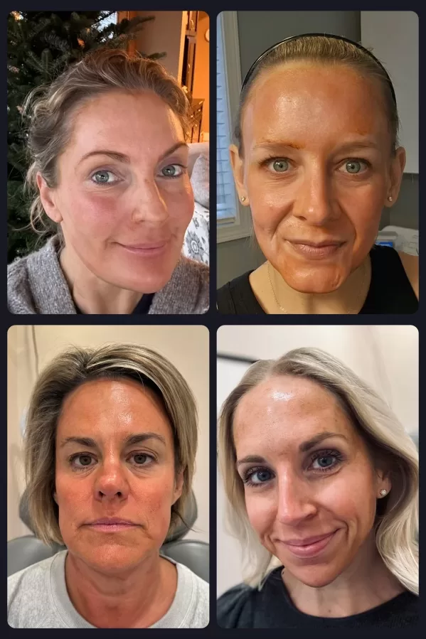 Photo of four females with chemical peel solution on their faces before being washed off
