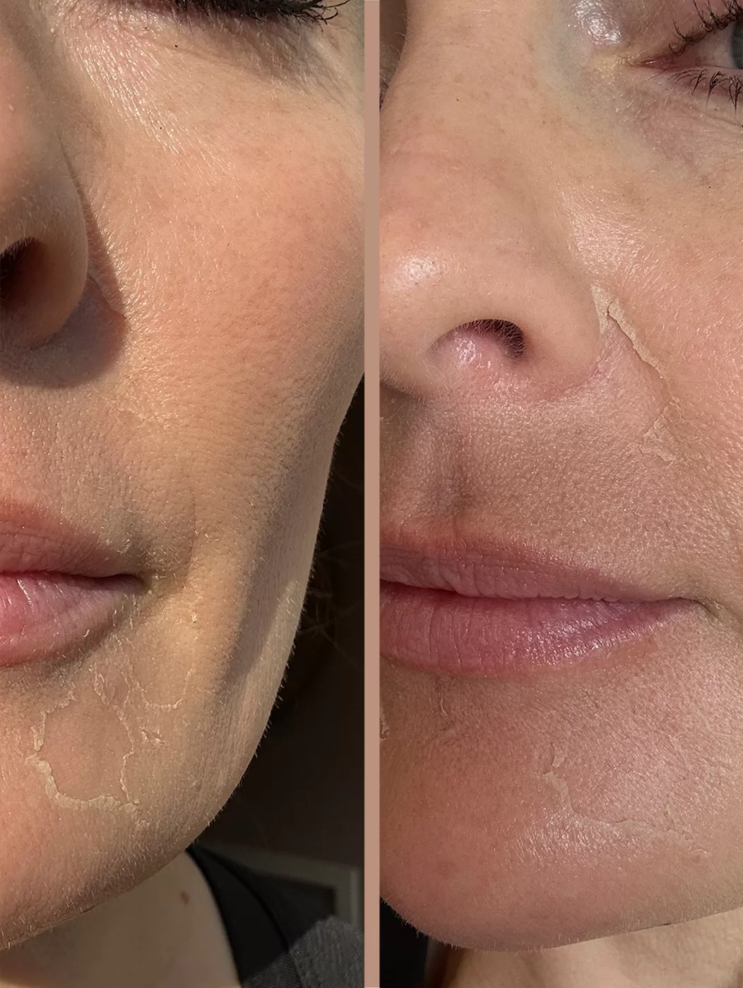 Chemical Peel Healing DaybyDay Recovery Process