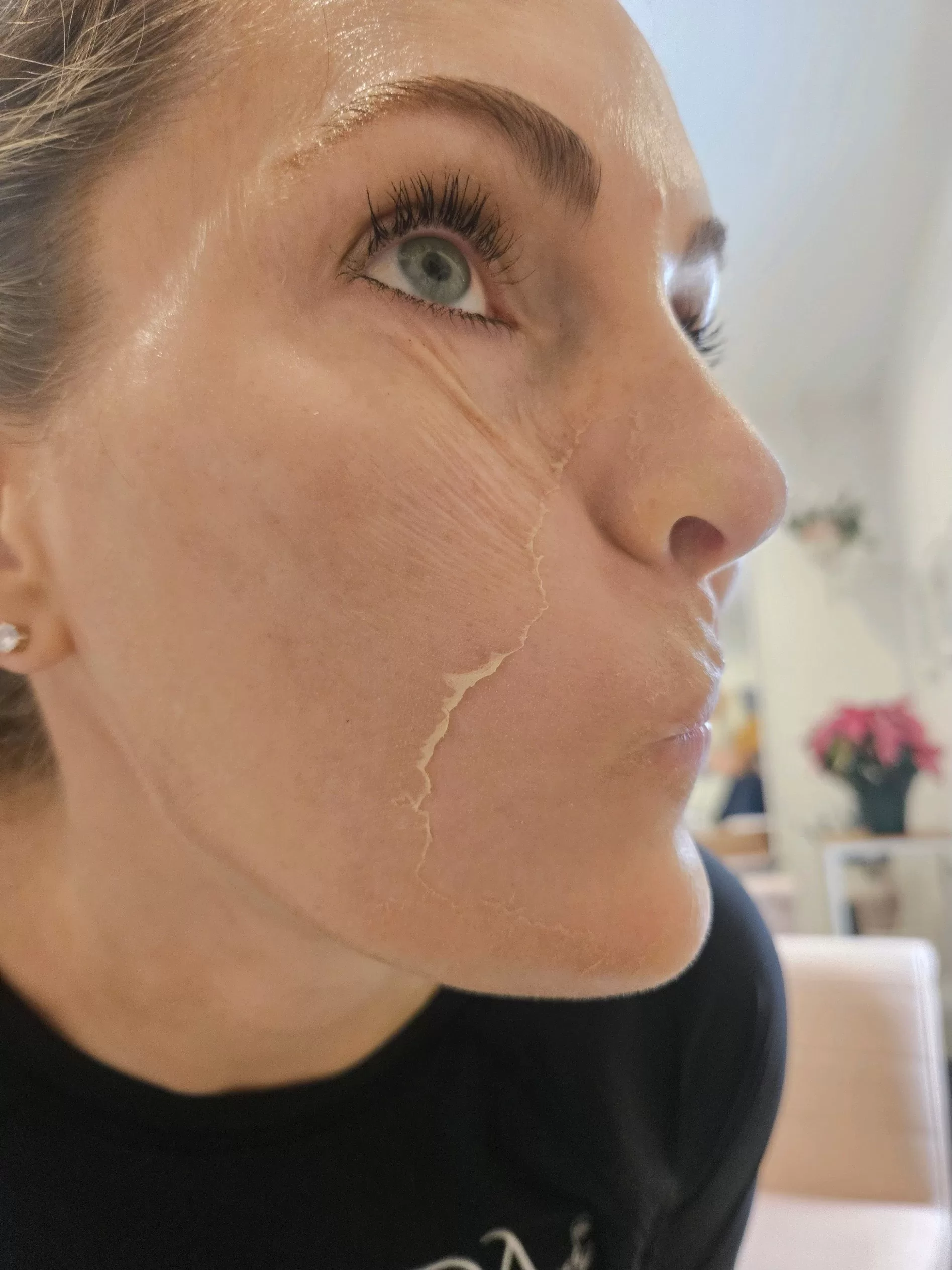 close up of female with skin flaking off her cheek from a chemical peel