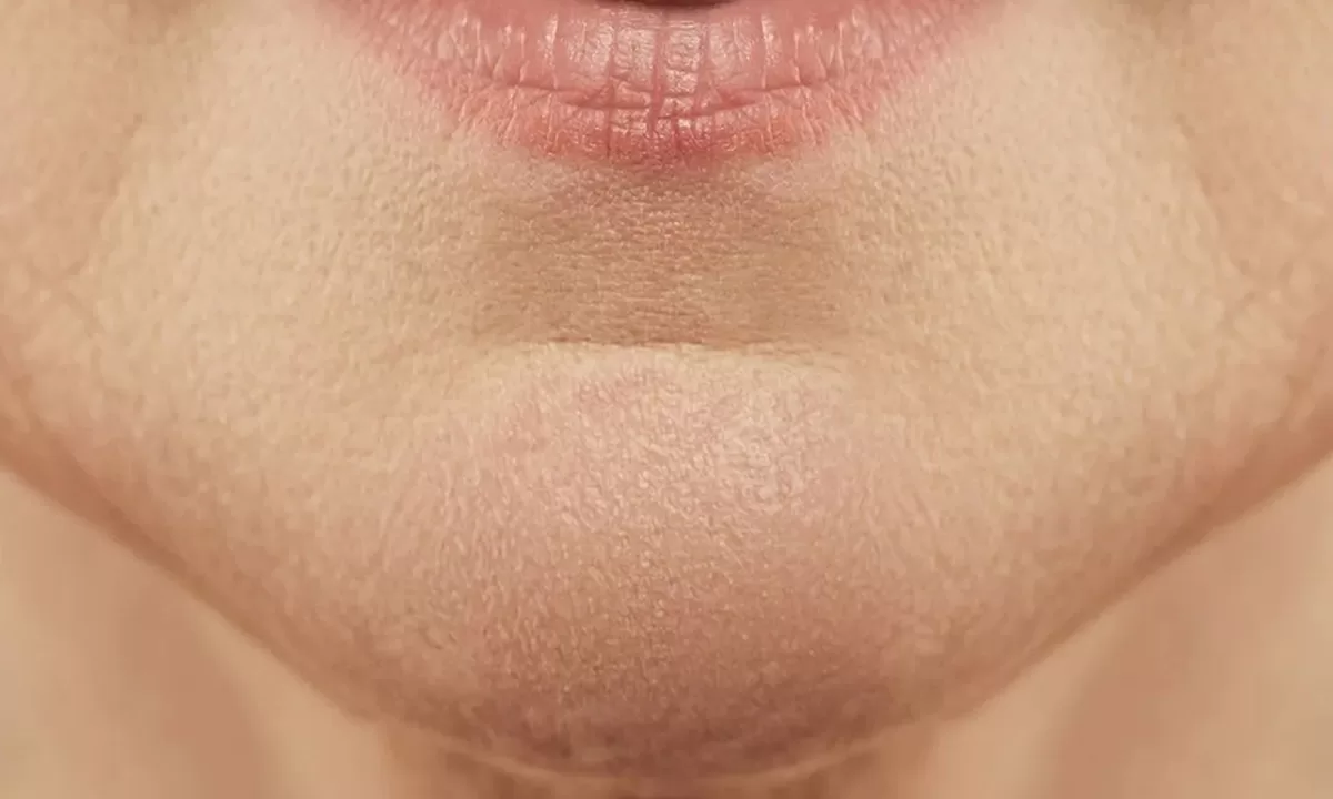 close up of female with mental crease (chin wrinkles)