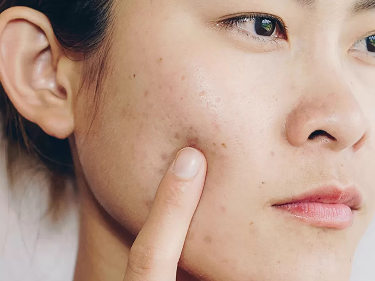 female with acne as a result of retinol purging