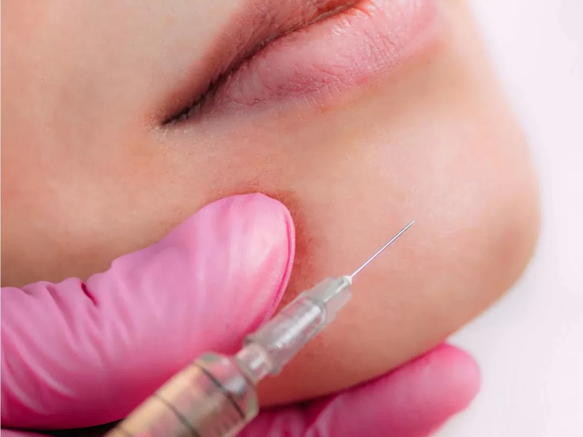 close up of female injected with filler in chin
