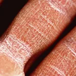 close up of dry skin on hands and fingers