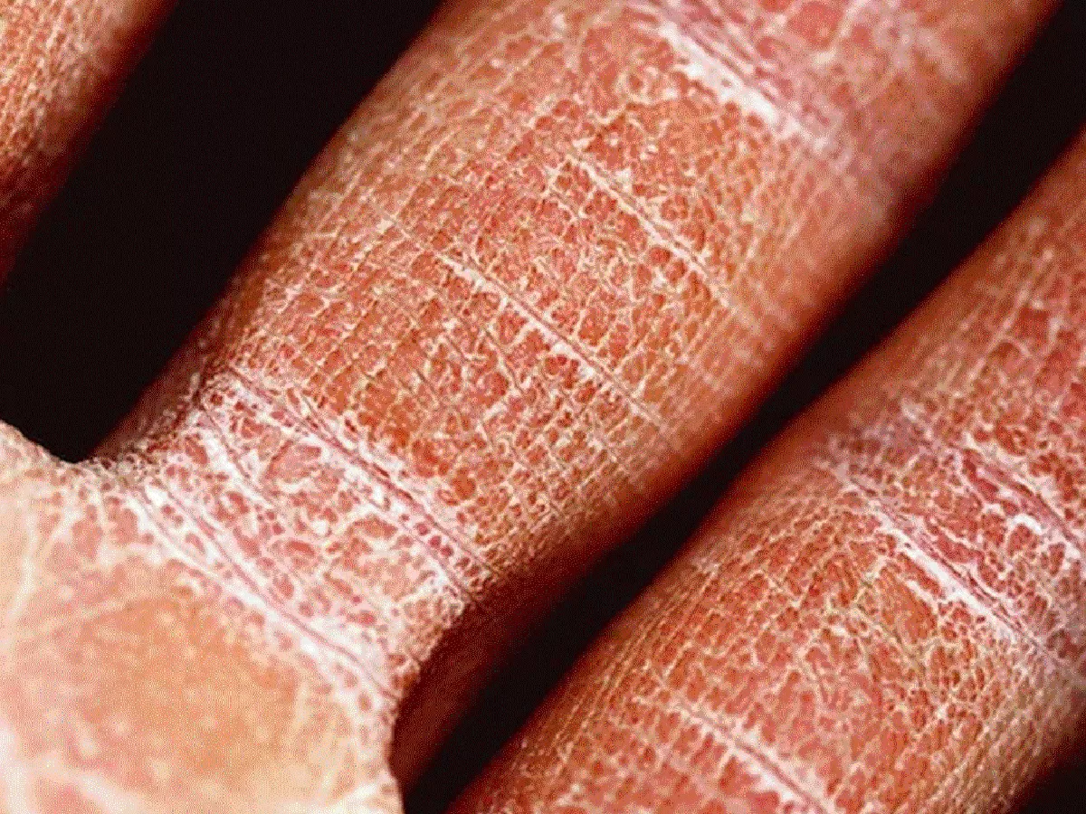 close up of dry skin on hands and fingers