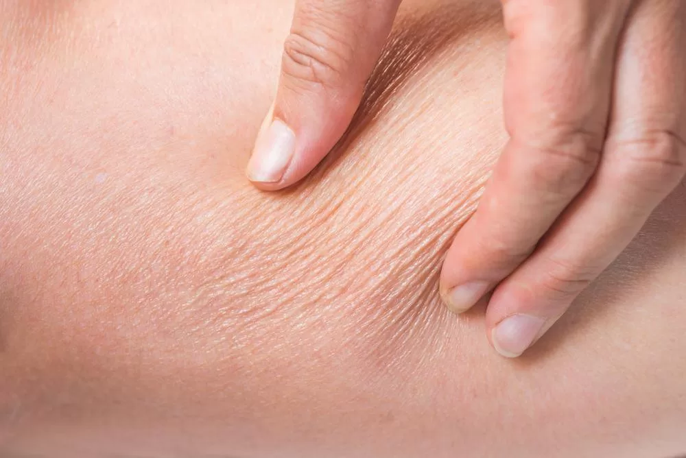 pinching skin demonstrating dryness