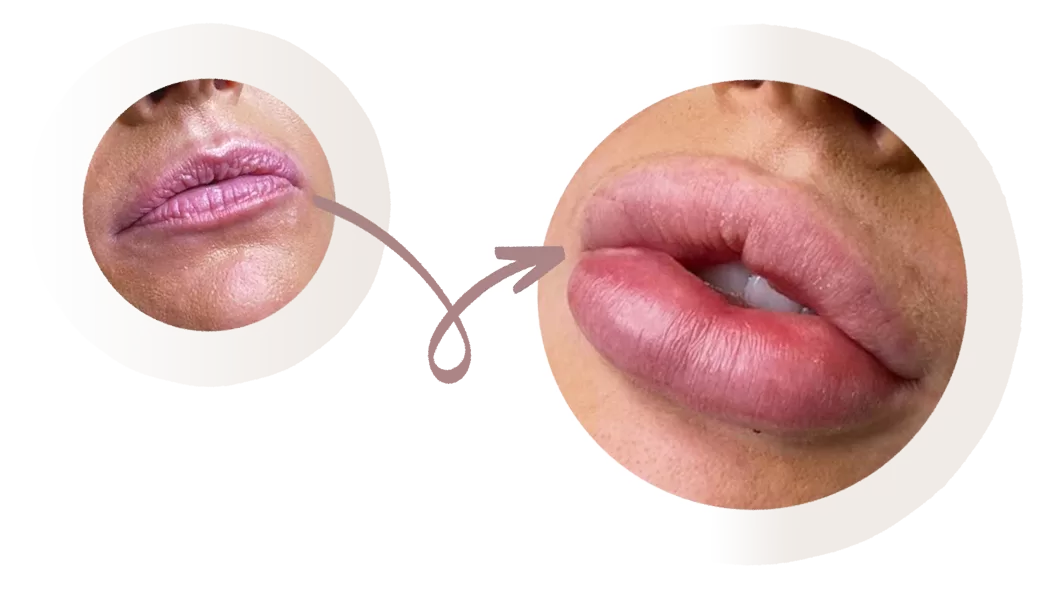 Lip filler before and after