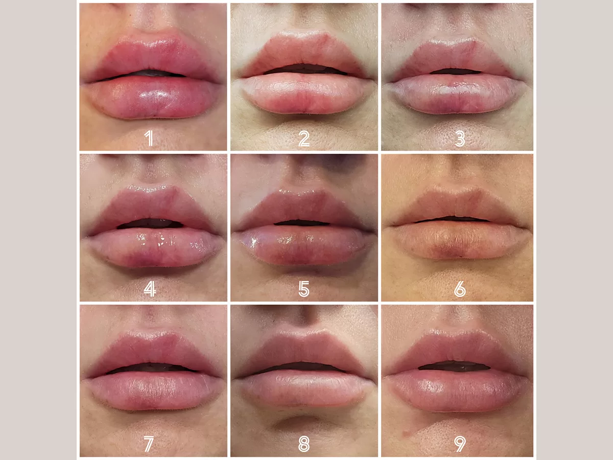 lip filler healing process timeline